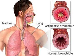 bronkitis